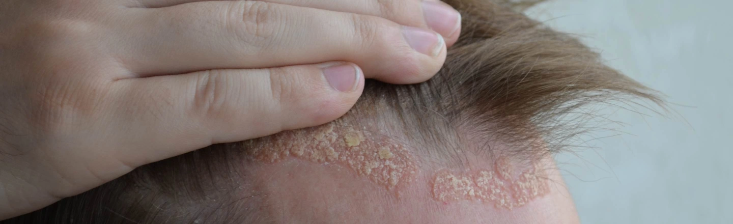 síntomas dermatitis seborreica
