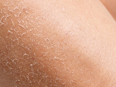 piel deshidratada tras el verano