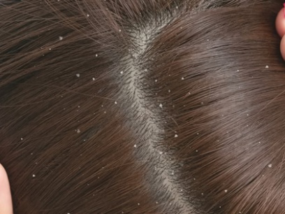 por que sale la caspa