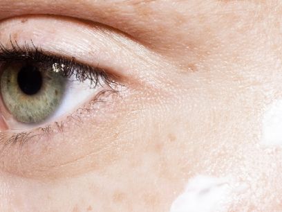 93.-tratamientos-medicos-para-cuidar-contorno-de-ojos