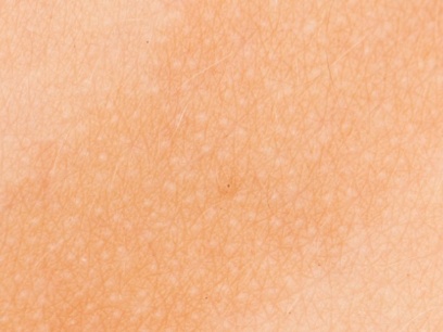 manchas marrones en la piel