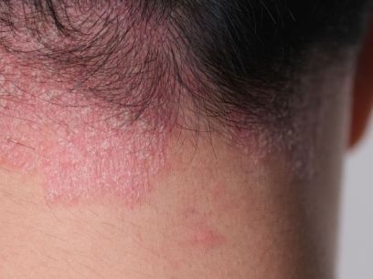 138.-que-es-y-como-tratar-la-dermatitis-seborreica