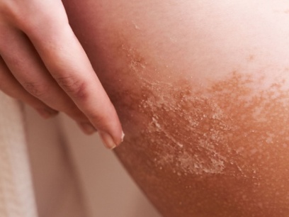 tratar queratosis actínica