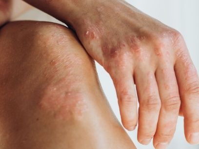 Qué es la queratosis actínica