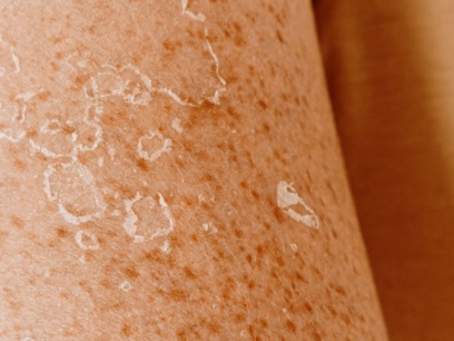 queratosis actínica
