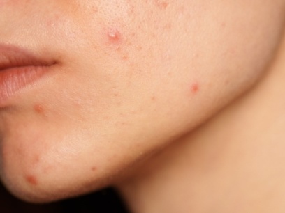 piel acneica cuidados