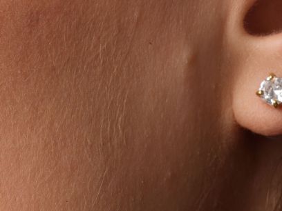 207.-acne-adulto-causas-tratamientos