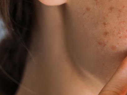 Preguntas sobre el acné