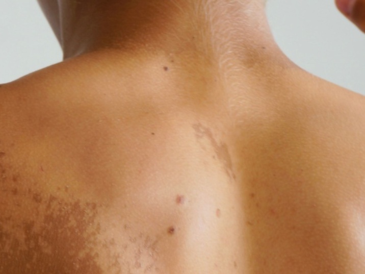 Daño solar en la piel