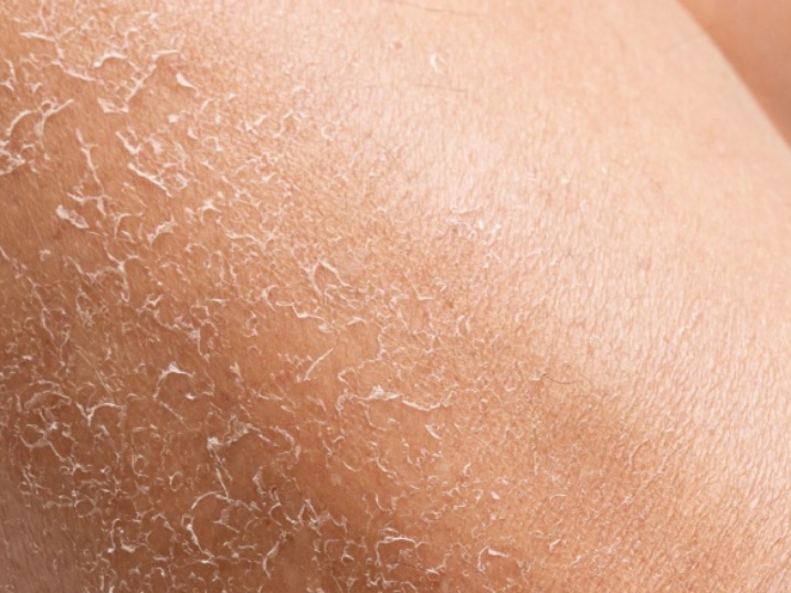 piel deshidratada tras el verano