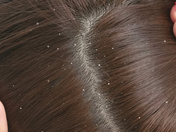 por que sale la caspa