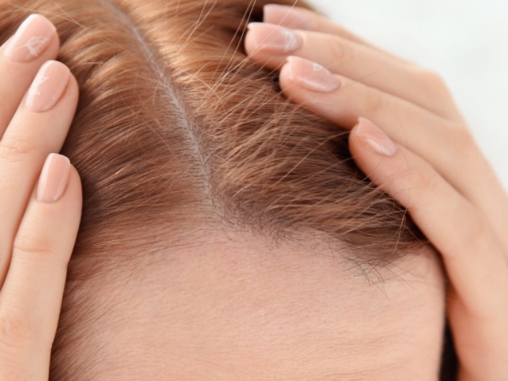 Caída de pelo hormonal