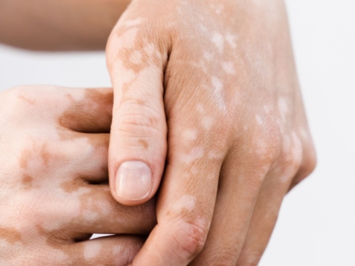 Manchas blancas en la piel