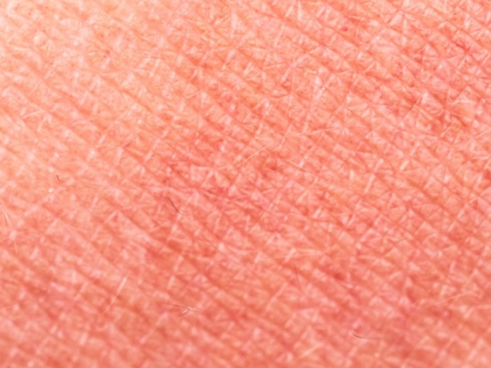 manchas rojas en la piel