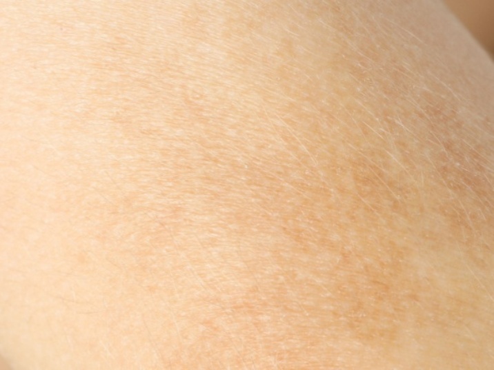 niacinamida para manchas