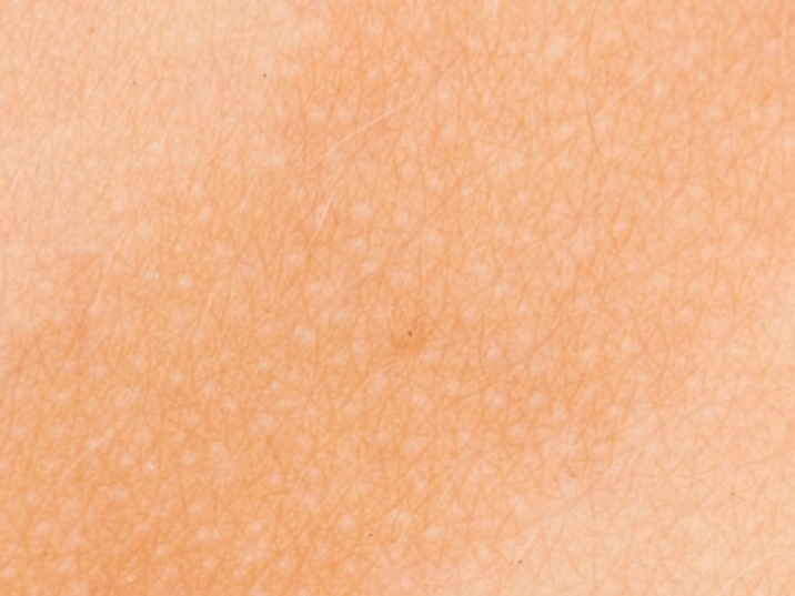 manchas marrones en la piel