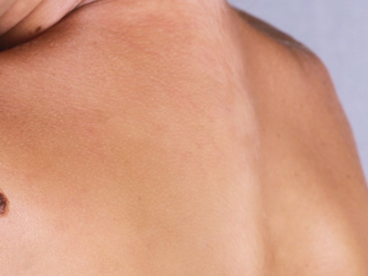 Despigmentación de la piel