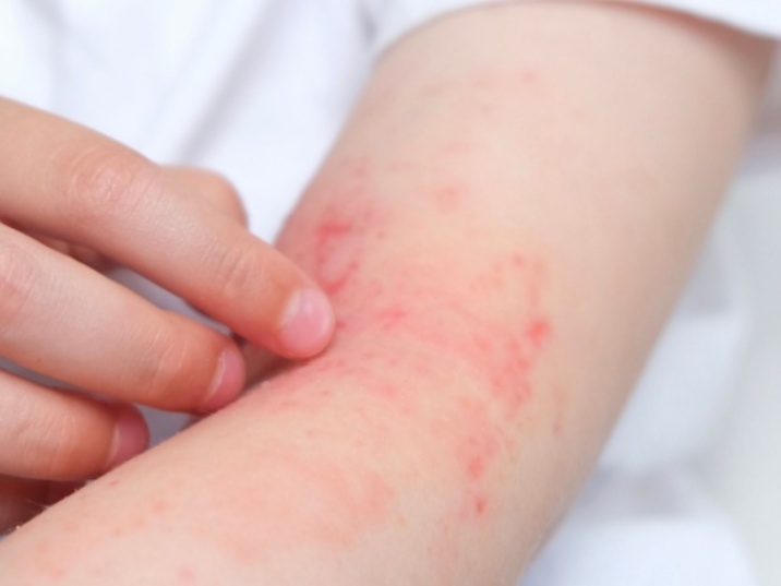 Piel atópica en niños