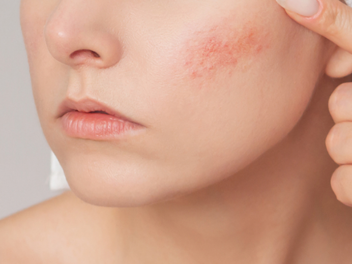 protección solar pieles sensibles