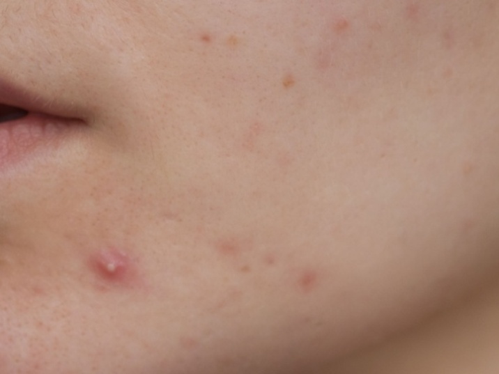 Rutina para piel grasa