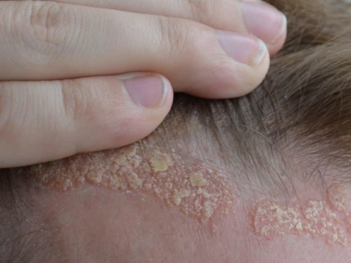 síntomas dermatitis seborreica