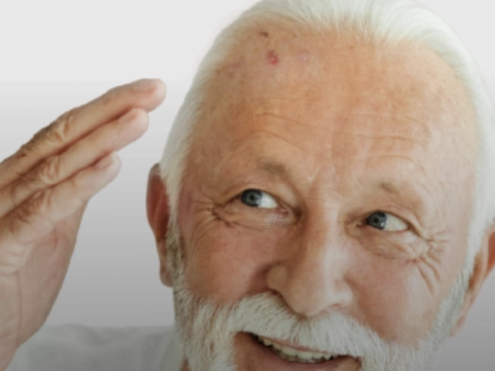 qué es la queratosis actínica