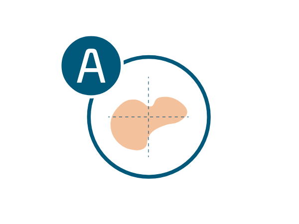 melanoma-regla-a