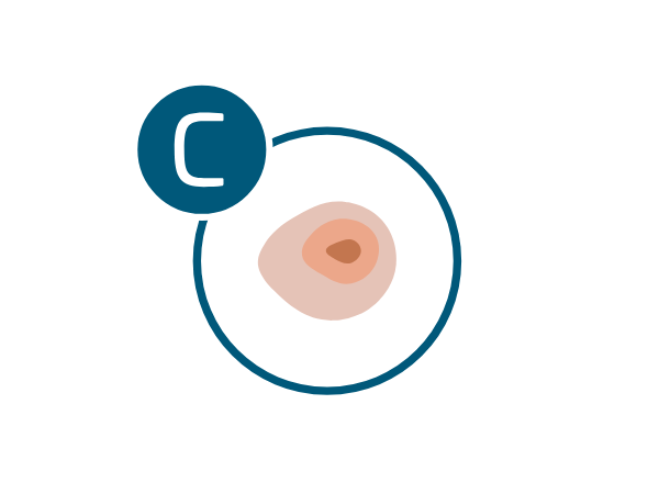 melanoma-regla-c