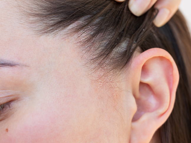 qué es la dermatitis seborreica