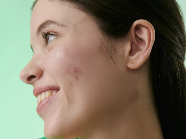 Biretix isorepair Beneficios_600x450-08