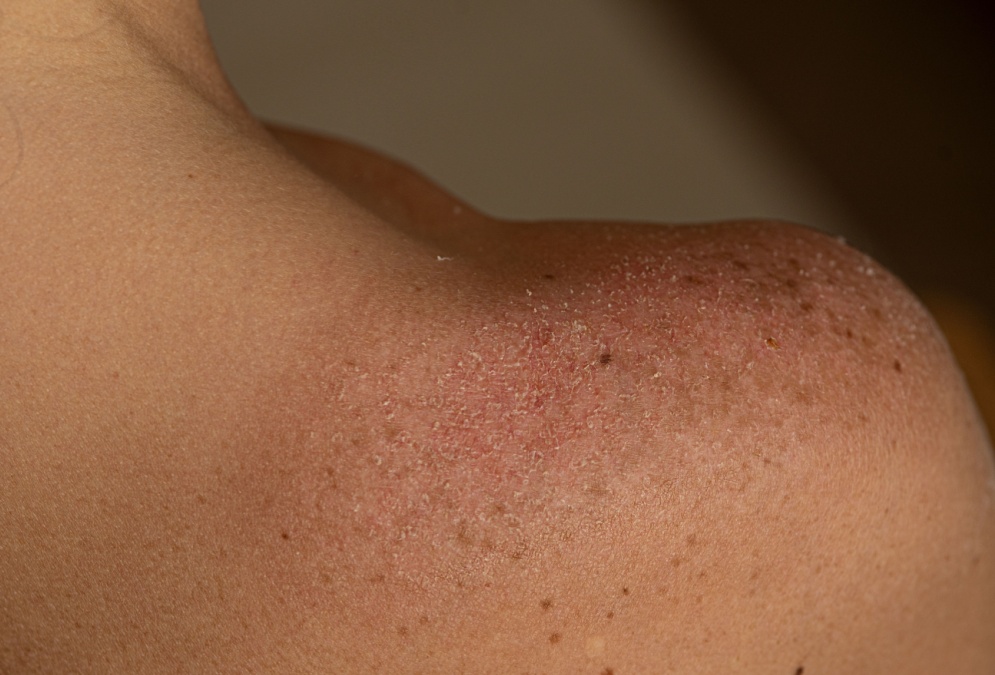 ProteccionSolar_manchas_995x675