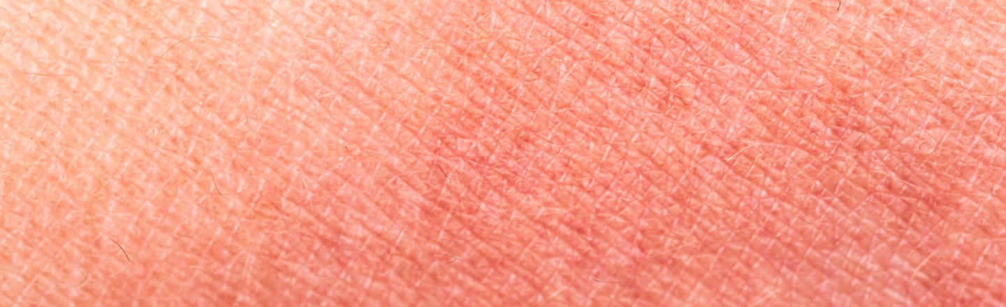 manchas rojas en la piel