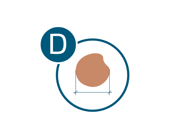 melanoma-regla-d