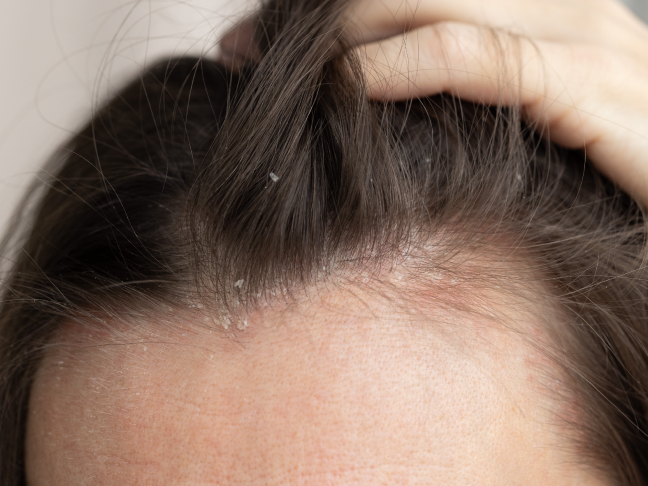 dermatitis seborreica cuero cabelludo