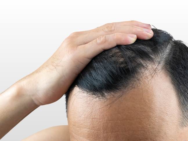 alopecia androgenética