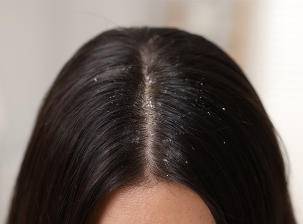 cómo tratar la caspa