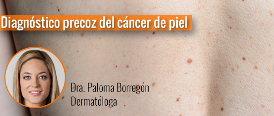 Diagnóstico precoz del cáncer de piel