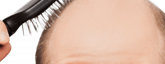 mitos-tratamiento-alopecia